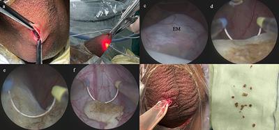 The Application of Scrotoscope-Assisted Minimally Invasive Excision for Epididymal Mass: An Initial Report